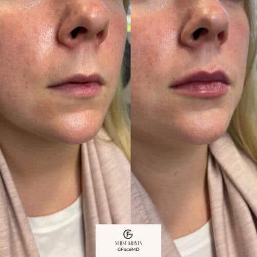 Lip treatment | gfacemd | Wellesley