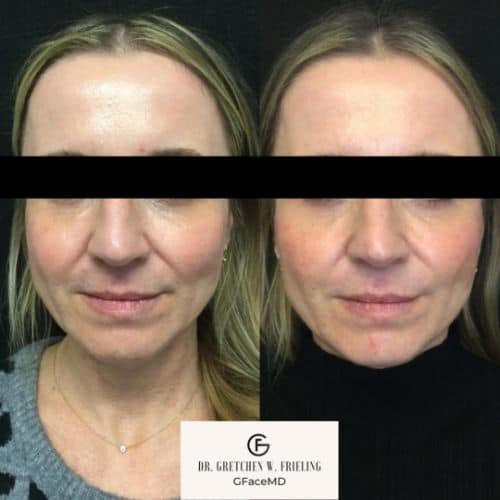 Facelift treatment | gfacemd | Wellesley