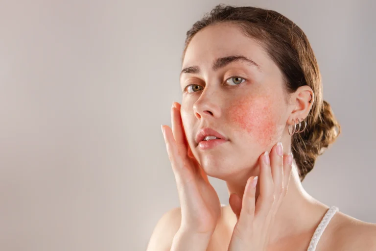 Rosacea- Identifying Triggers and Finding Relief