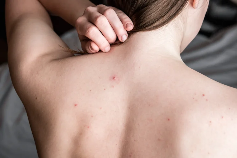 How to Treat and Prevent Acne on the Back: A Comprehensive Guide