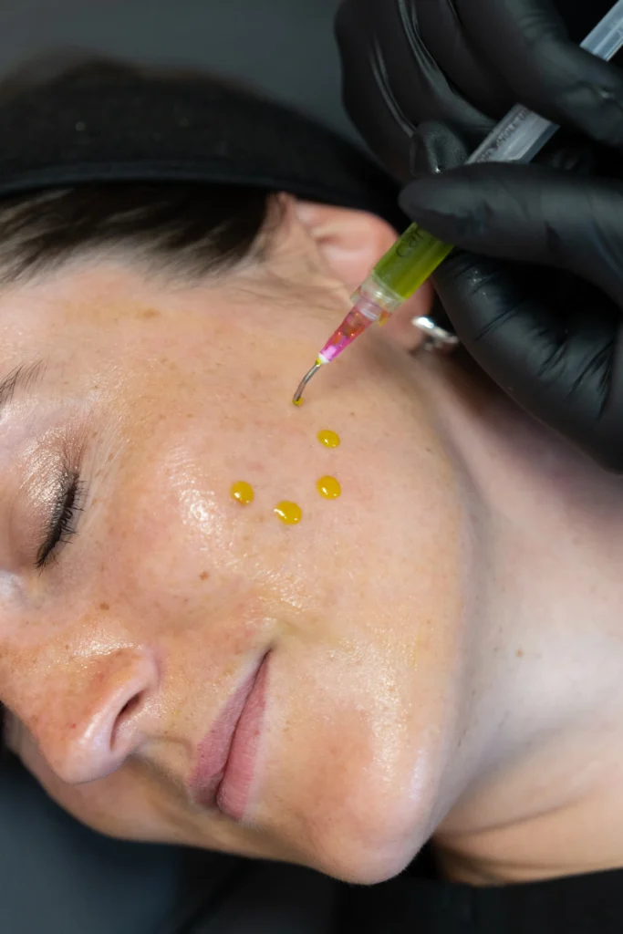 Portfolio 4 Chemical Peels