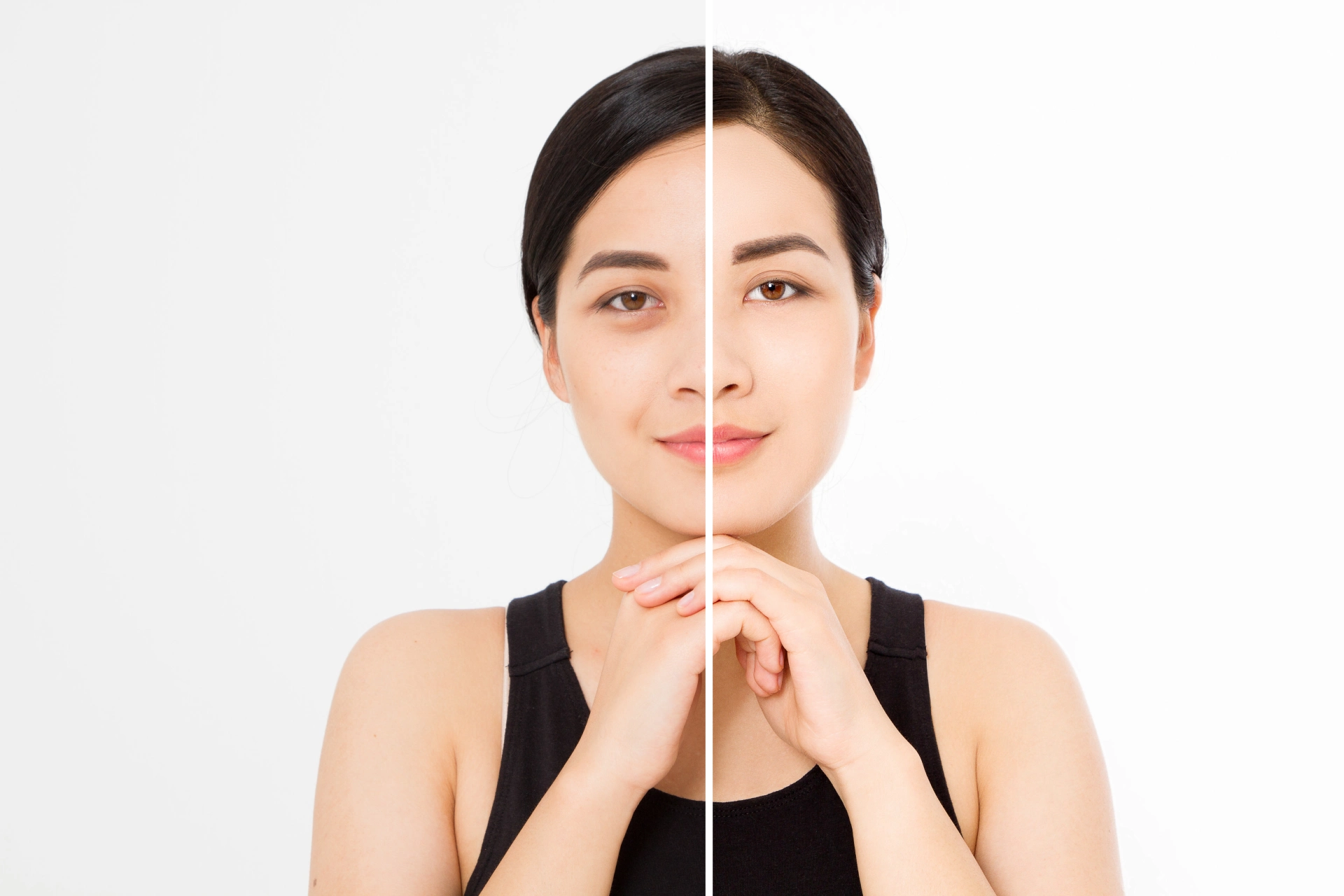Woman showing before and after improvement in under-eye hollows