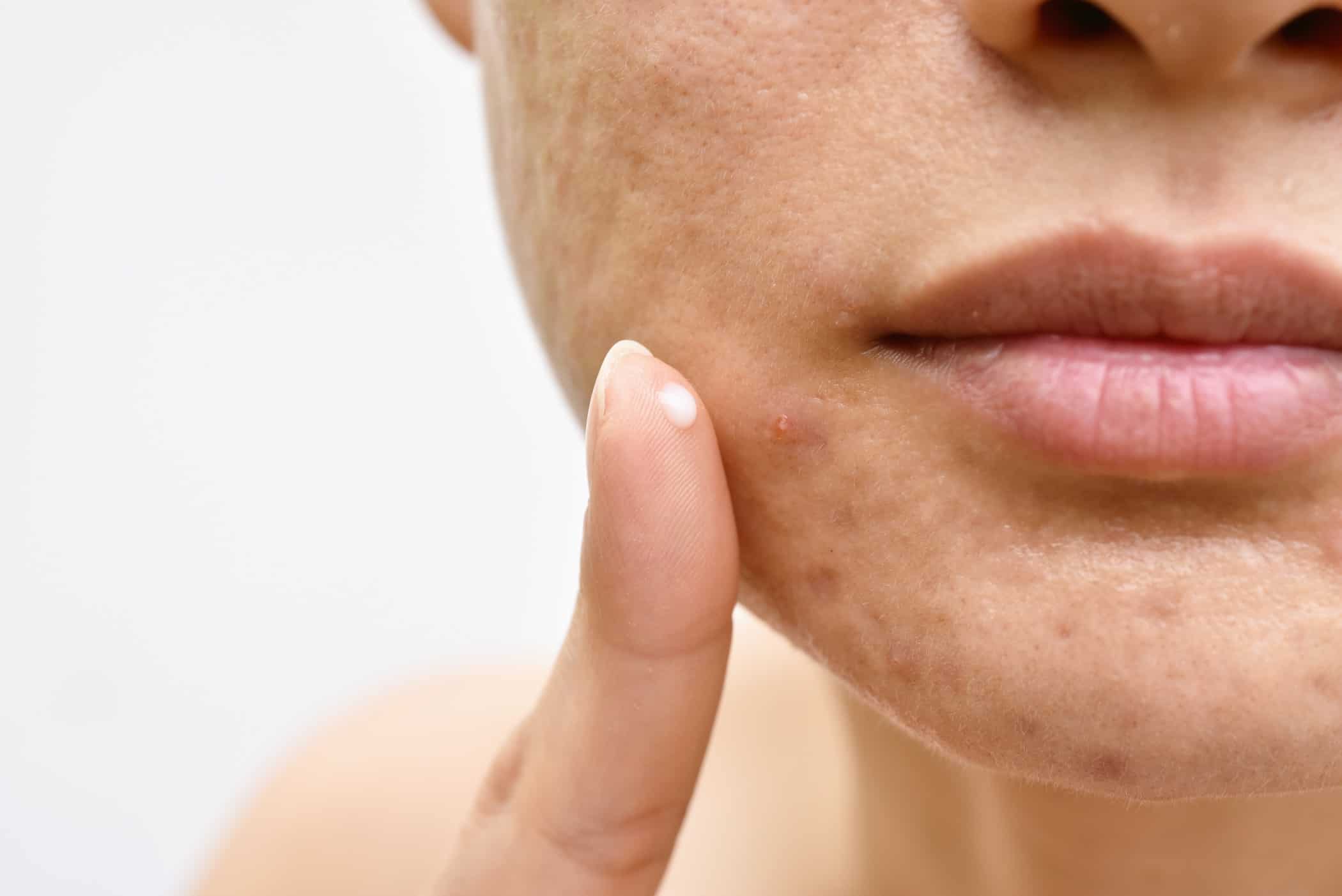 Women Applying Cream on Face | gfacemd | Wellesley