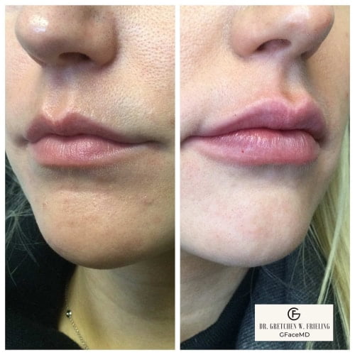 Lip treatment | gfacemd | Wellesley